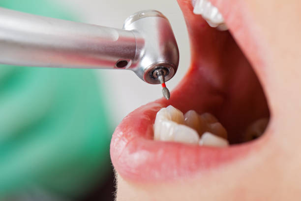 Best Emergency Tooth Extraction in Bay City, OR